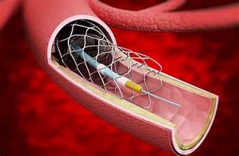 Embolic Protection Device Market Size And Report Forecast 2024-2032