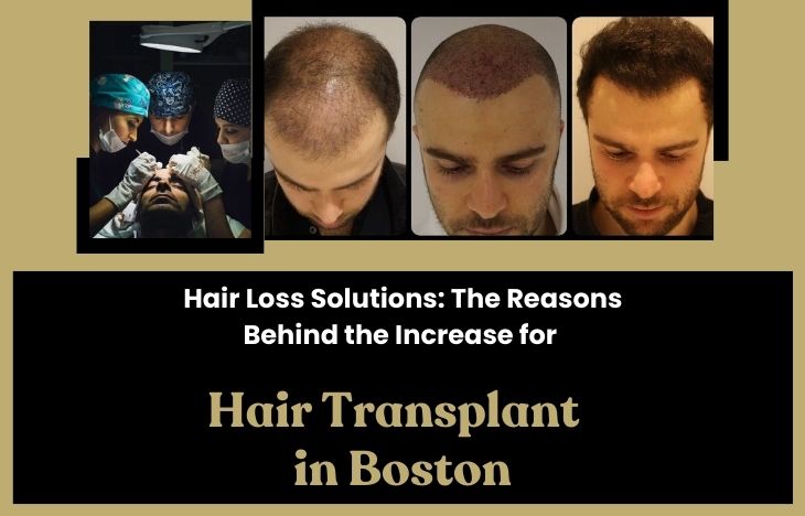 Hair Loss Solutions: The Reasons Behind the Increase for Hair Transplant in Boston