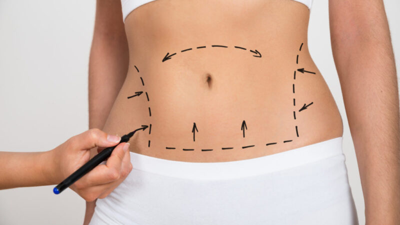 Liposuction Surgery in Dubai