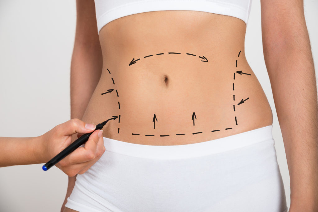 Liposuction for the Stomach Flattening Your Belly