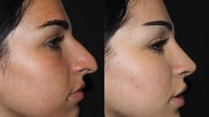 Rhinoplasty Consultation in Dubai: What to Expect