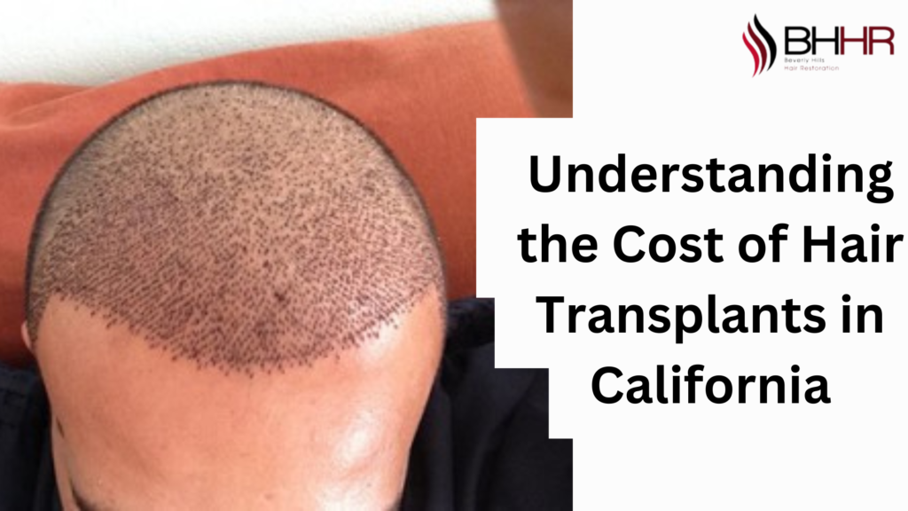 hair transplant cost in california