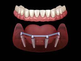 Achieve Lasting Results with Dental Implants