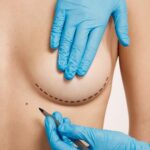 Breast Augmentation: Choosing the Right Surgeon