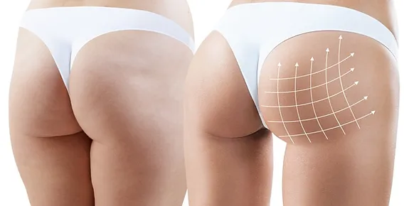 The Best Aesthetics Clinic in Dubai for Safe and Effective Butt Fillers