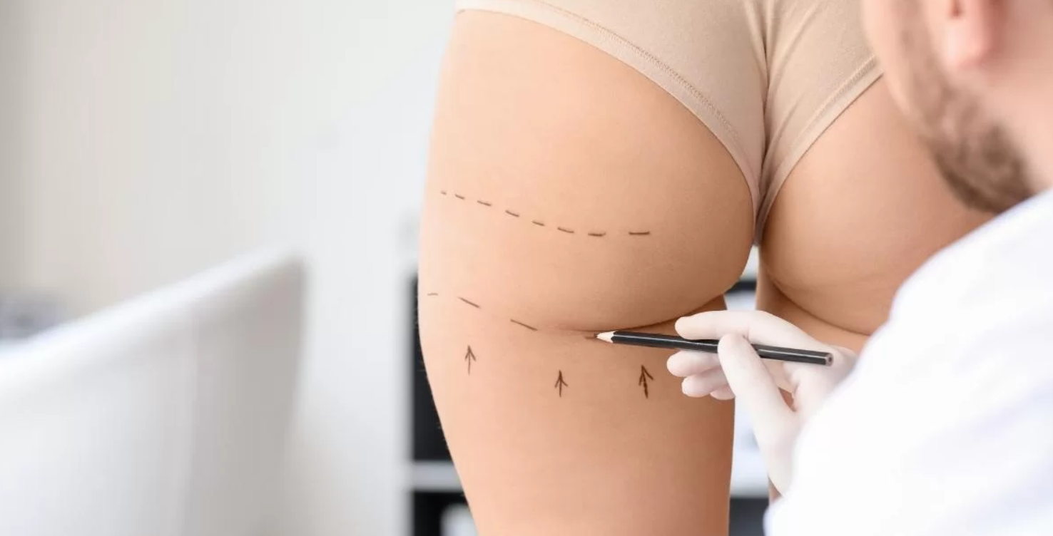 Post-Operative Care Tips from the Best Butt Fat Transfer Surgeons in Dubai