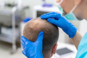 Long-Term Benefits of Hair Transplant in Dubai