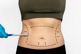 Liposuction Surgery in Dubai