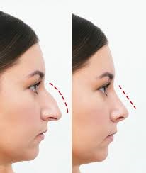 Rhinoplasty in Dubai