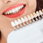 Composite Veneers: A Comprehensive Guide to Achieving Your Perfect Smile