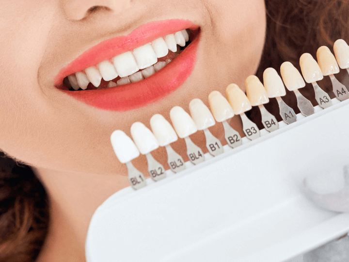 Composite Veneers: A Comprehensive Guide to Achieving Your Perfect Smile