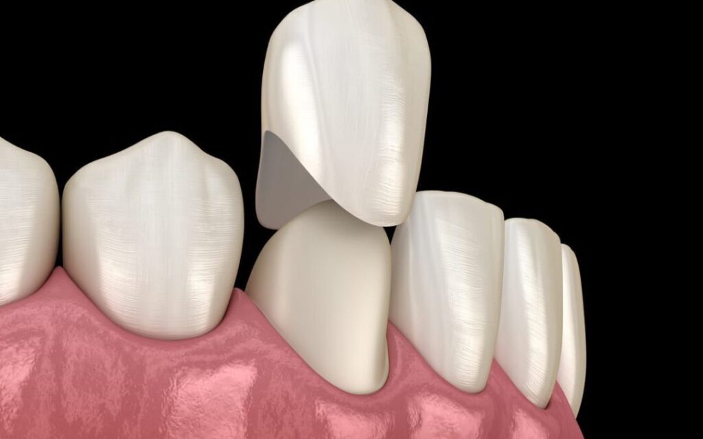 front teeth crowns