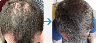 PRP Hair Treatment London: How to Find the Best PRP Clinic