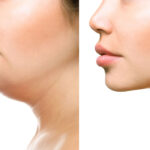 Before and After: Transformations from the Best Jawline Fillers Dermatologist in Dubai