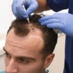 تكلفة زراعة الشعر في دبي