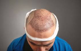 Elevate Your Look with Hair Transplant in Riyadh