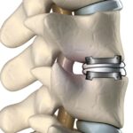 Why Consider Disc Replacement Surgery Unveiling Its Numerous Benefits