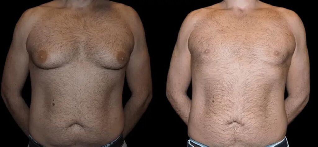 Transform Your Chest with Best Gynecomastia Surgeons in dubai