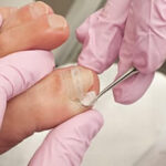 Ingrown Toenail Removal in San Antonio