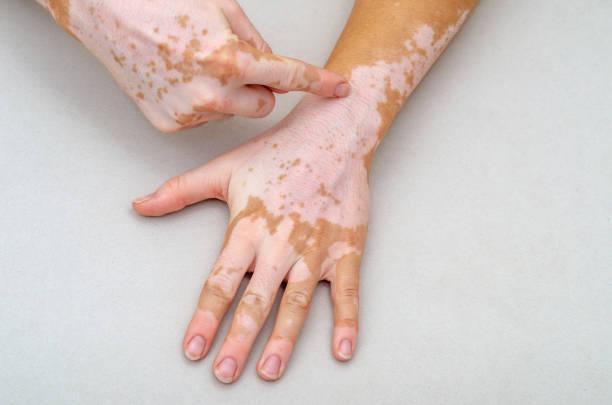 Understanding Vitiligo: Vitiligo Treatment in Ayurveda for Skin Restoration