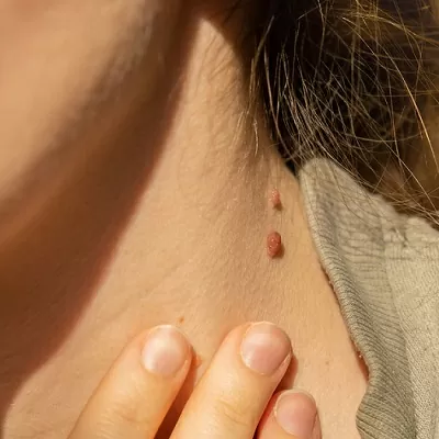 Can I remove a skin tag myself?