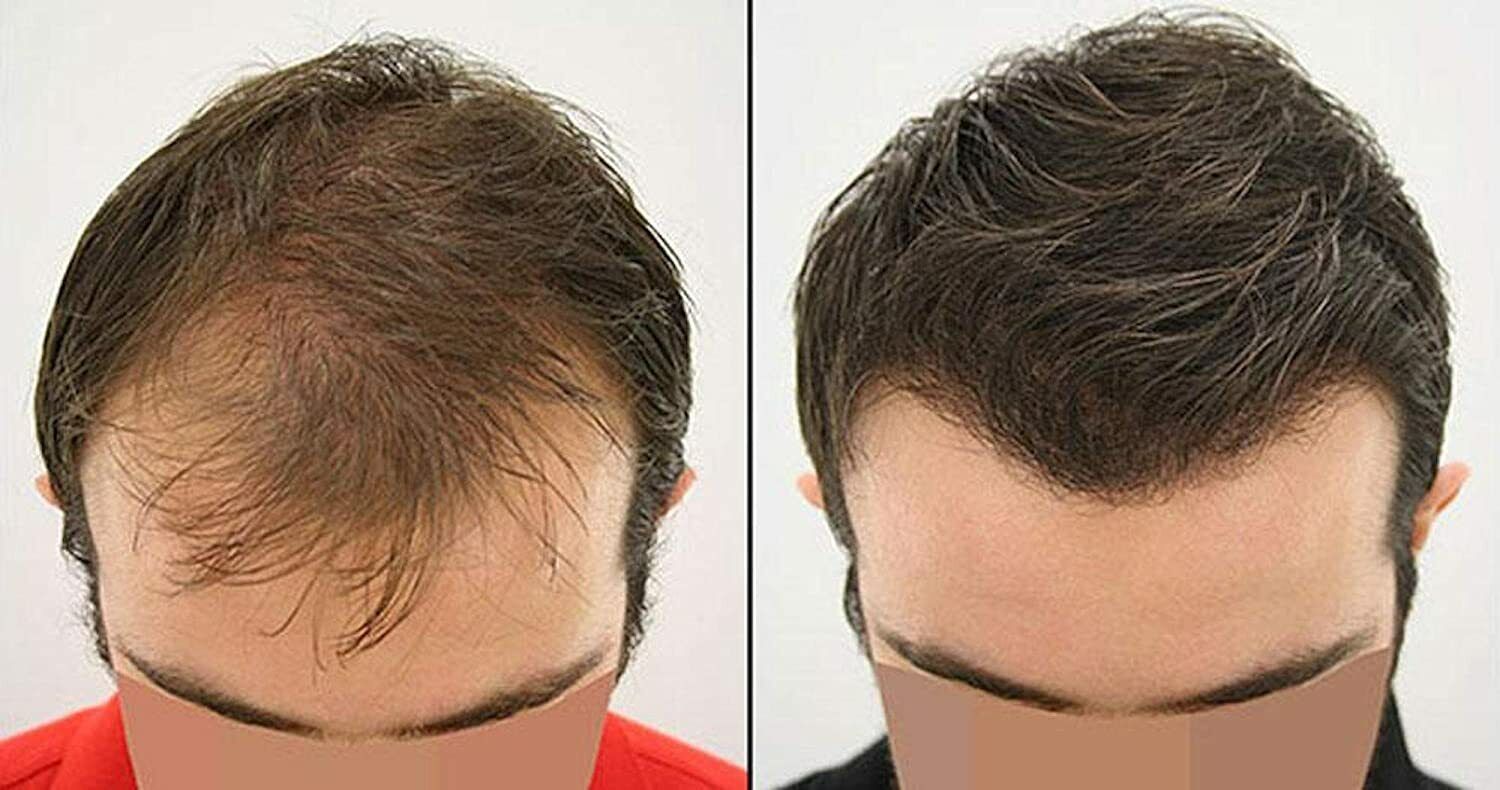 هل زراعة الشعر في دبي آمنة للنساء الحوامل؟