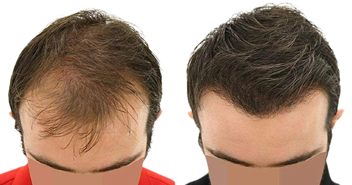 Hair Transplant in Dubai: Say Goodbye to Baldness!