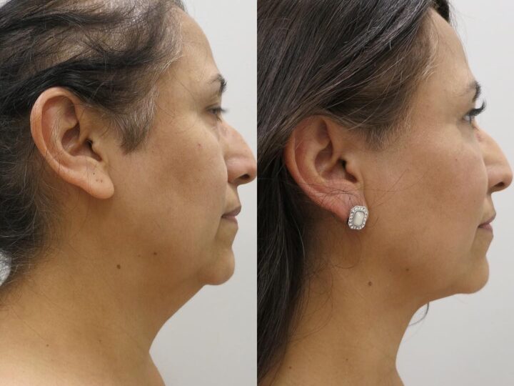 What Are the Benefits of Neck Liposuction and How to Find the Best Plastic Surgeons in Houston?