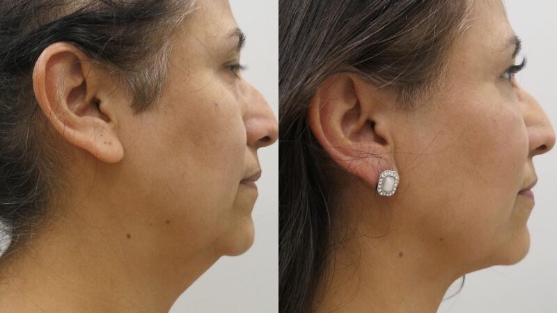 What Are the Benefits of Neck Liposuction and How to Find the Best Plastic Surgeons in Houston?