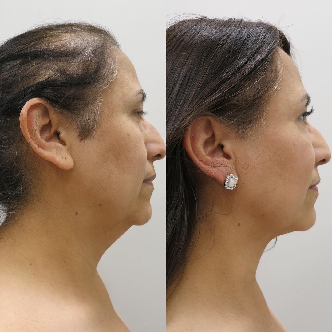 What Are the Benefits of Neck Liposuction and How to Find the Best Plastic Surgeons in Houston?