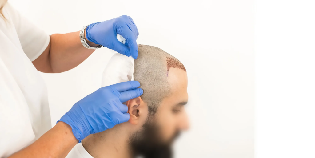 Hair Transplant Treatment in Mumbai 